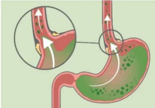 寧波供卵試管：做試管需要對精子怎么處理，需要預(yù)洗嗎